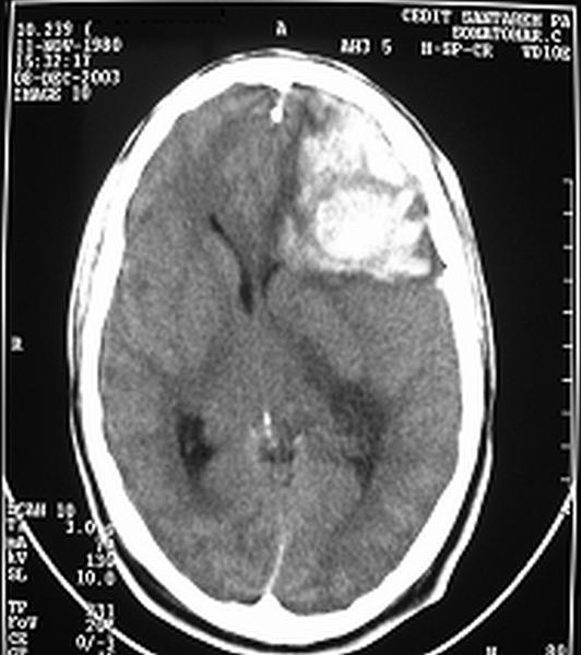 Figure 4: 

Intracranial bleeding 24 hours after a Lachesis bite
