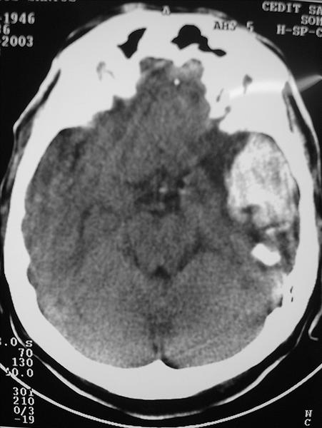 Figure 5: Intracranial bleeding in a 57 year old man 5 days after a Lachesis bite
