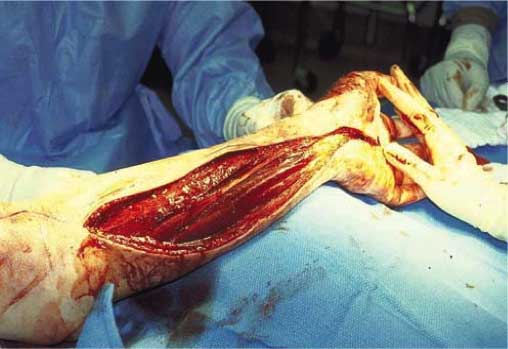 fasciotomy3